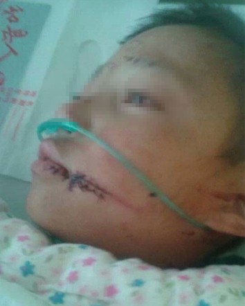 男童遭后母虐待 孩子被继母撕嘴挑手筋照片（组图）